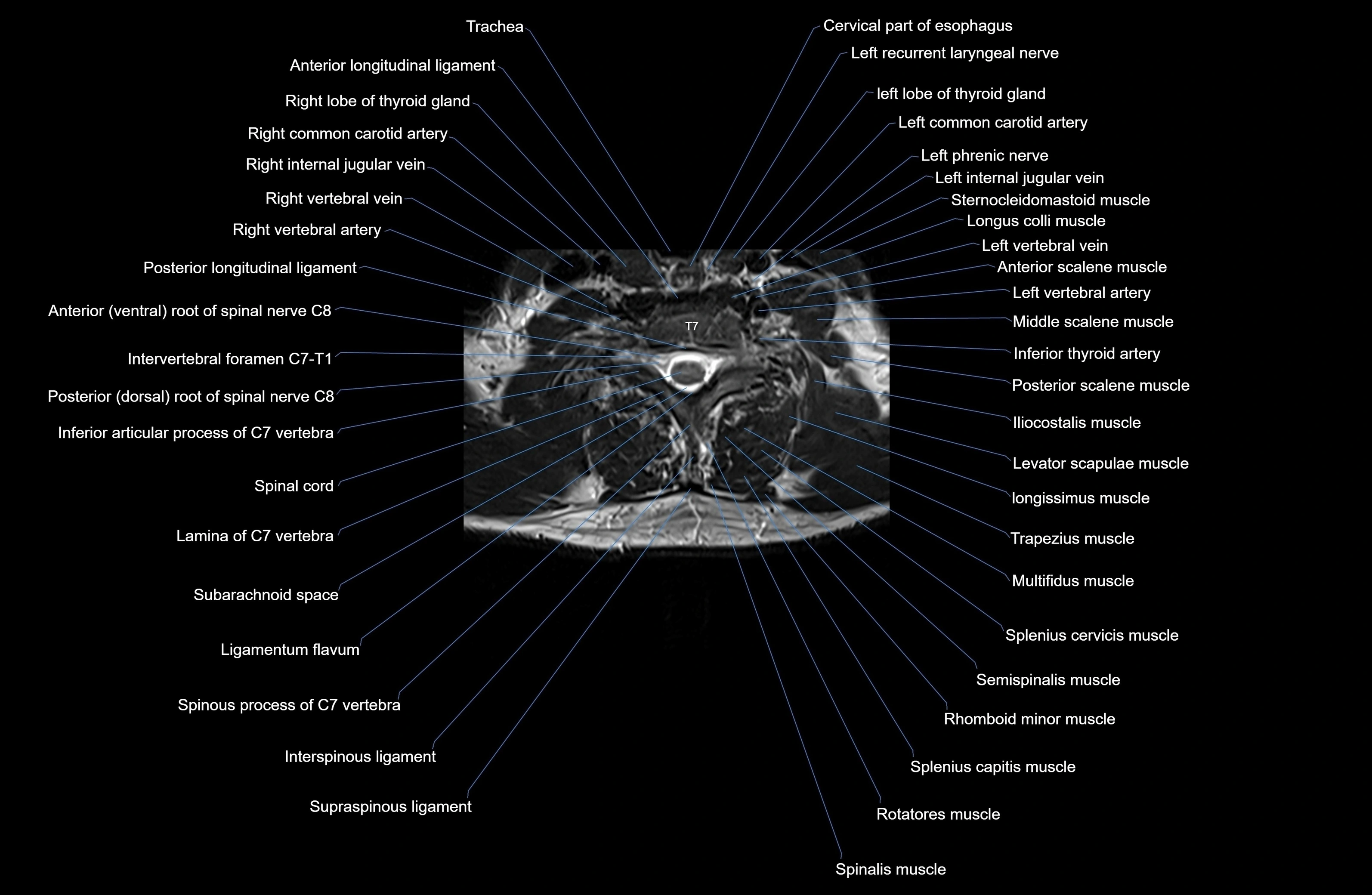 MRI thoracic spine axial  cross sectional anatomy 3T radiology  image-img-00001-00004.webp